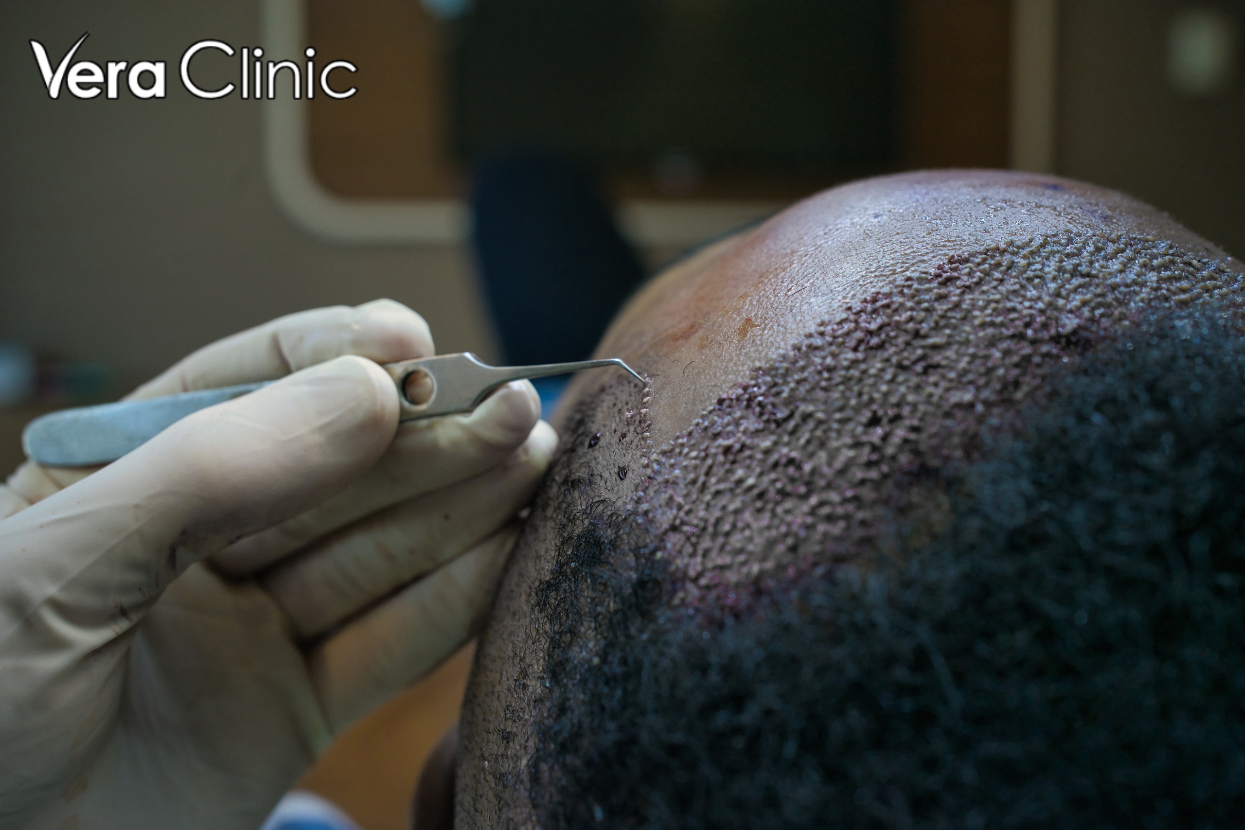 hair transplant turkey